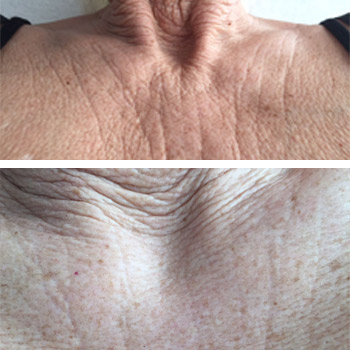 ACCOR Plasma Pen-Behandlung und Micro-Needling-Behandlung